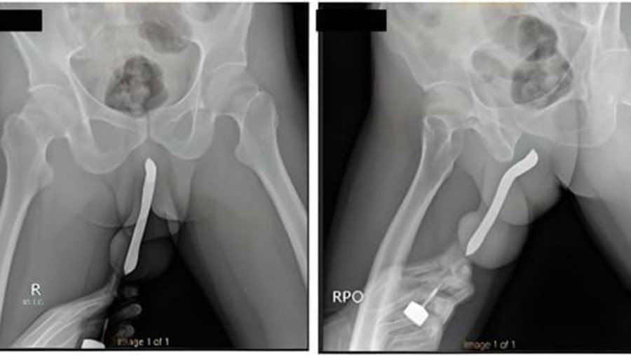 Man Fractures Penis During Sex After Toothbrush Breaks Inside Genital Organ