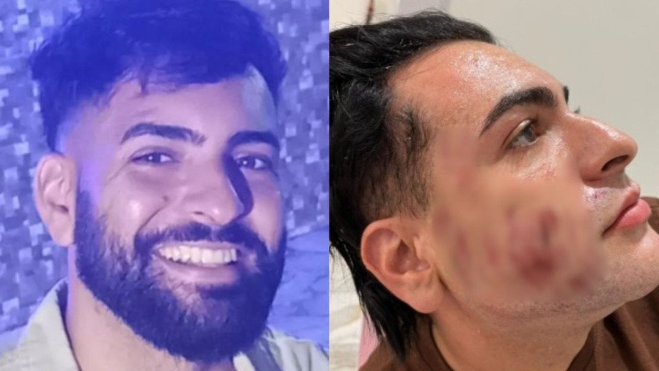 Man Dies After Having Phenol Peeling in Brazil