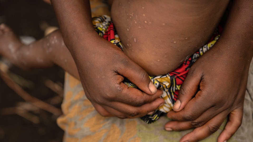Mpox. Child Cases Increase by 75 in Congolese Province