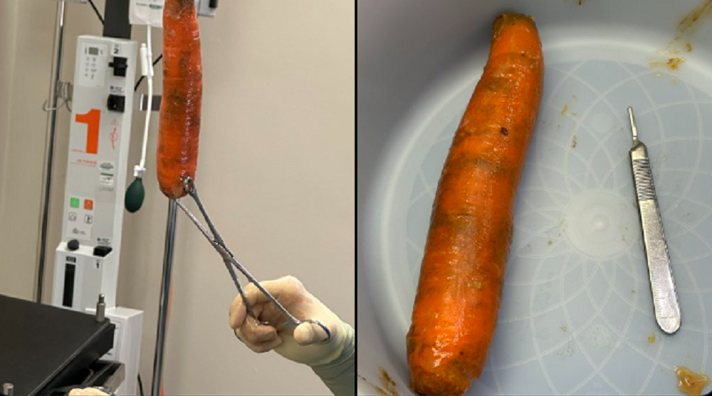 Man Goes to Hospital After Inserting 'Giant' Carrot into Anus