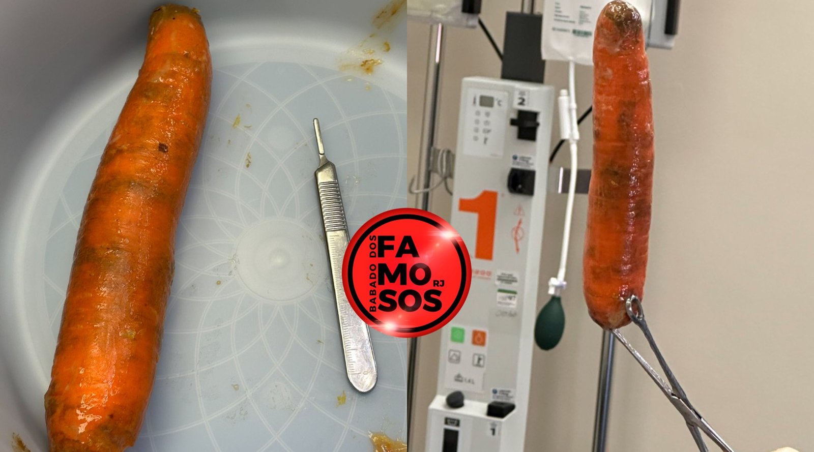 Homem Foi Parar No Hospital Com Uma Cenoura Dentro Do Ânµs