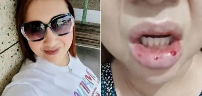 Mulher Sofre Reação Grave Após Usar Creme Dental Da Colgate E Vai À Justiça: “Fui Motivo De Chacota”