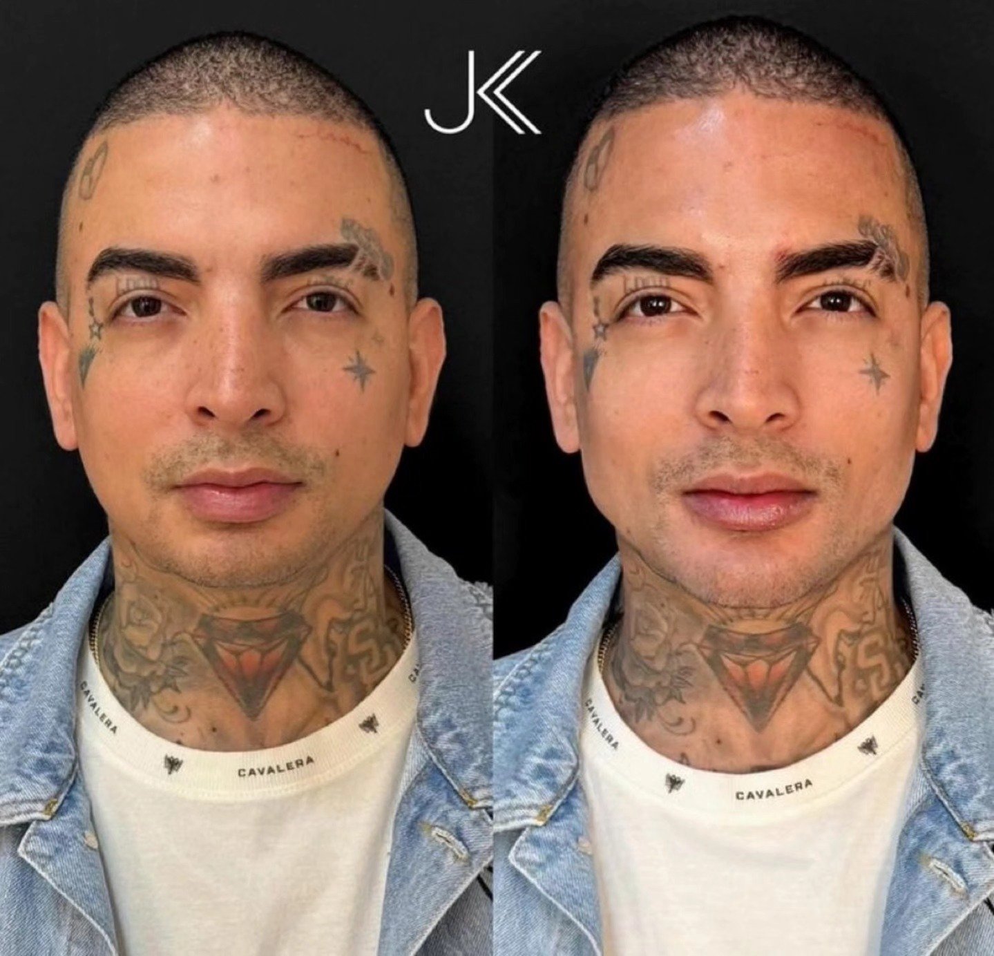 MC Guimê Aparece com Novo Rosto Após Harmonização Facial — Visual Divide Opiniões