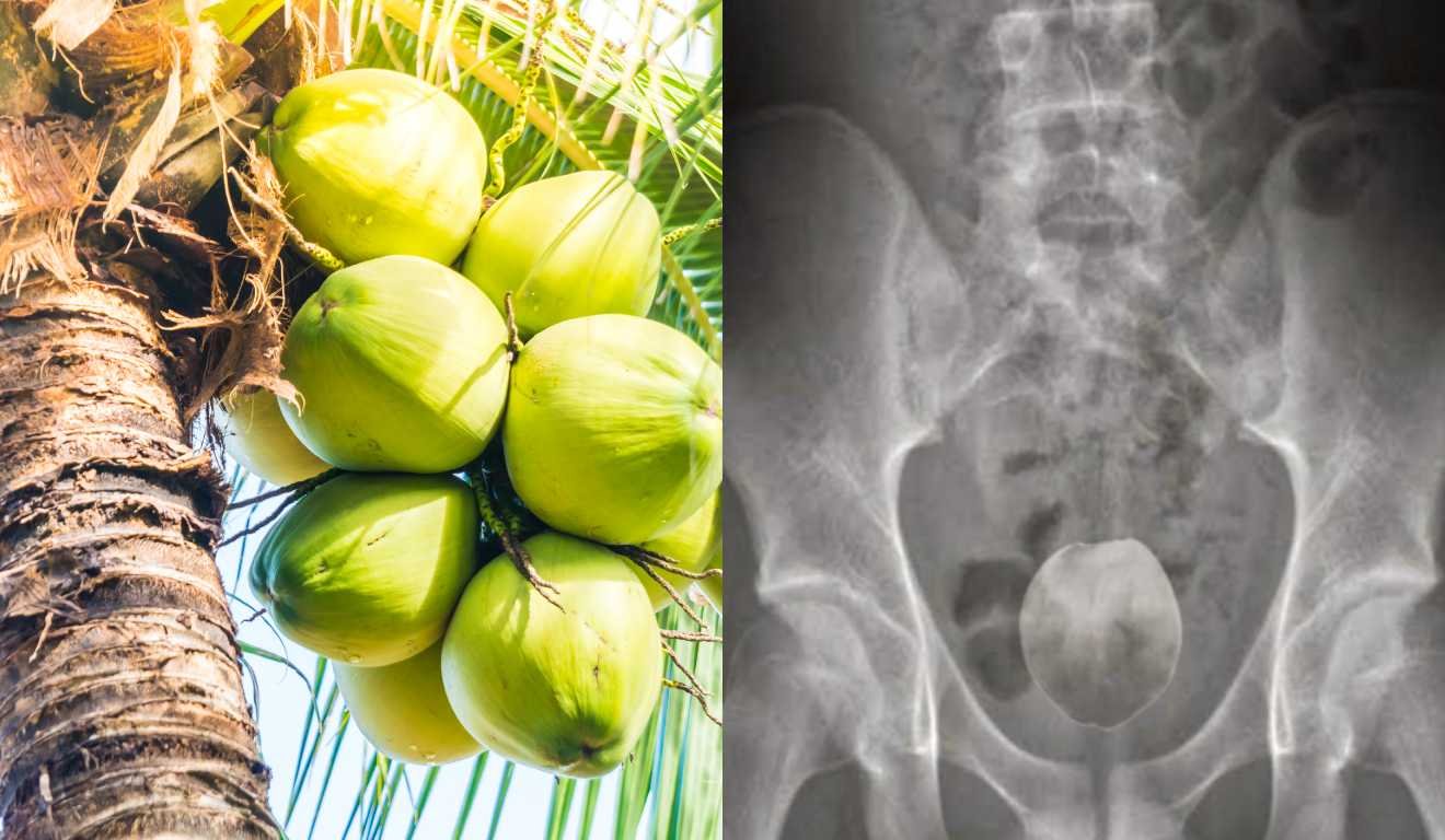 Homem Internado em MT após Inserir Coco no Ânµs