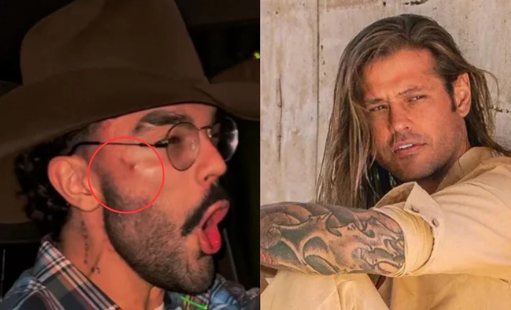 Hematomas No Rosto De Luan Pereira Chamam Atenção Após Crise Entre Dado Dolabella e Wanessa