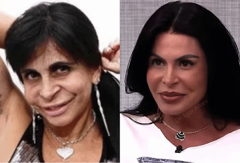 Gretchen Surge Com ‘Novo Rosto’ E Rebate Críticas! Veja O Antes E Depois